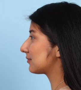 Rhinoplasty 22 B