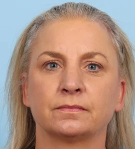 Rhinoplasty 23 A