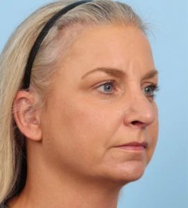 Rhinoplasty 24 A