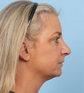 Rhinoplasty 25 B (2)