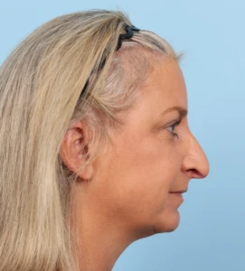 Rhinoplasty 25 B