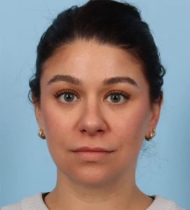 Rhinoplasty 26 A