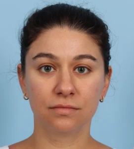Rhinoplasty 26 B