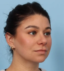 Rhinoplasty 27 B (2)