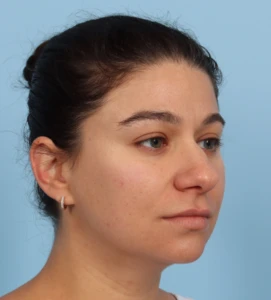 Rhinoplasty 27 B