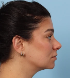 Rhinoplasty 28 A