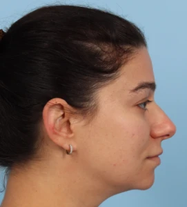 Rhinoplasty 28 B