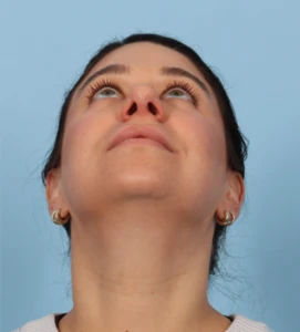 Rhinoplasty 29 A