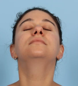 Rhinoplasty 29 B
