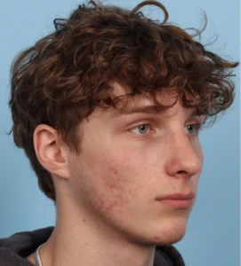 Rhinoplasty 3 A