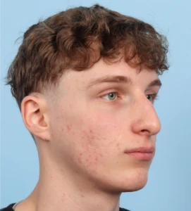 Rhinoplasty 3 B