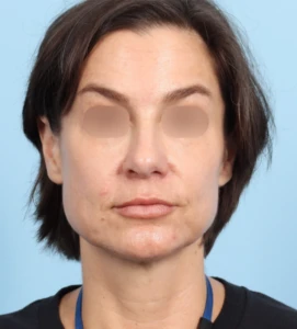 Rhinoplasty 30 A