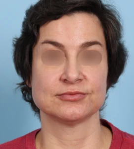 Rhinoplasty 30 B