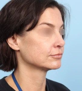 Rhinoplasty 31 A