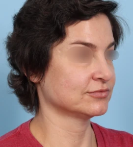Rhinoplasty 31 B