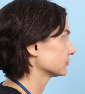 Rhinoplasty 32 B (2)
