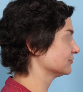 Rhinoplasty 32 B