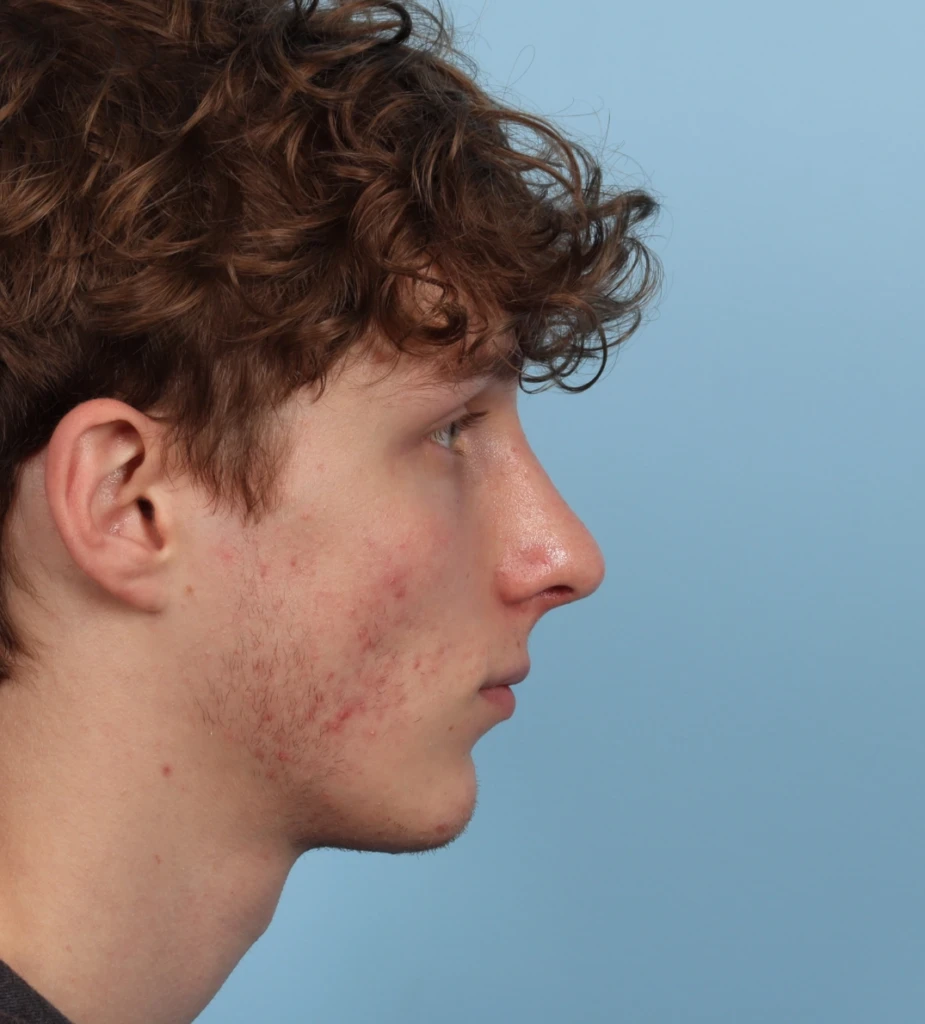 Rhinoplasty 4 A