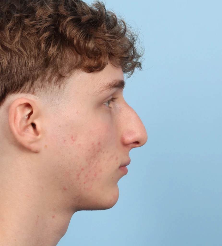 Rhinoplasty 4 B