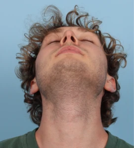 Rhinoplasty 6 A