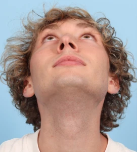 Rhinoplasty 6 B