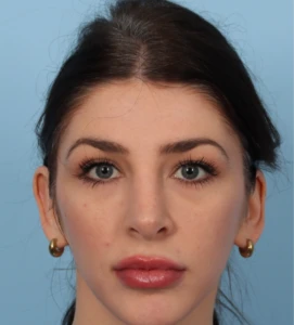 Rhinoplasty 8 A