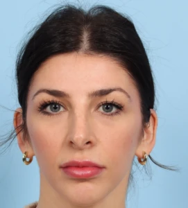 Rhinoplasty 8 B