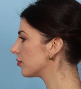 Rhinoplasty 9 A