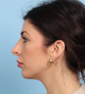Rhinoplasty 9 B
