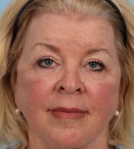 Upper Blepharoplasty 1 A