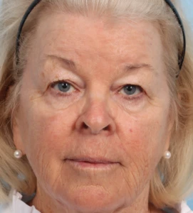 Upper Blepharoplasty 1 B