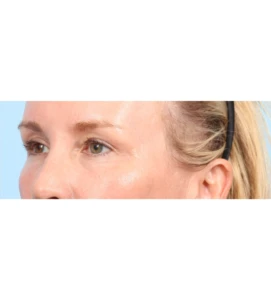 Upper Blepharoplasty 10 A