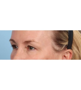 Upper Blepharoplasty 10 B