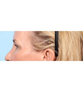 Upper Blepharoplasty 11 A