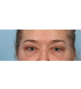 Upper Blepharoplasty 12 A