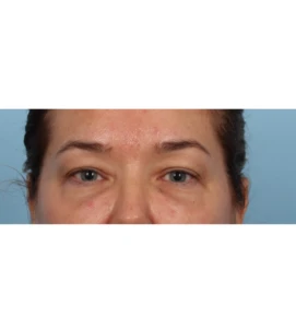 Upper Blepharoplasty 12 B