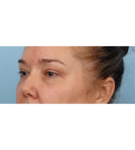 Upper Blepharoplasty 13 A