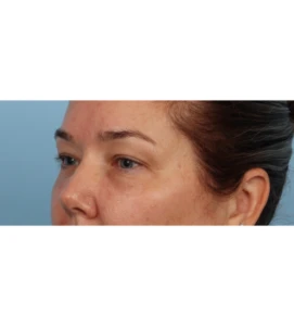 Upper Blepharoplasty 13 B