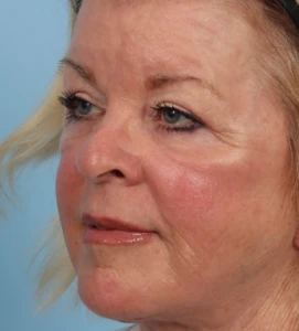 Upper Blepharoplasty 2 A