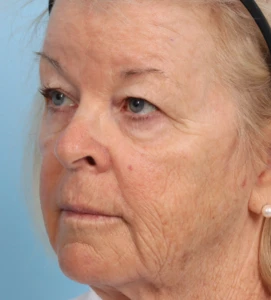 Upper Blepharoplasty 2 B
