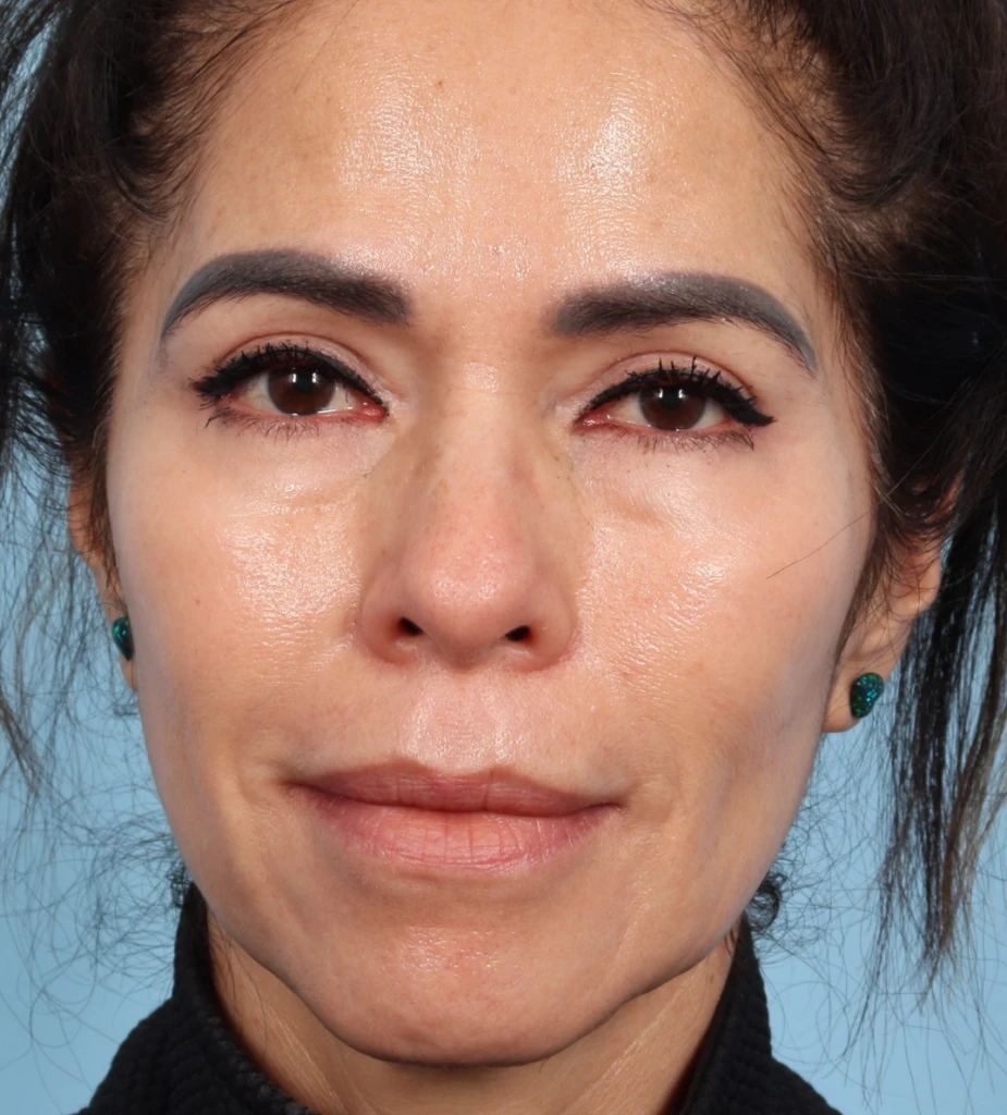 Upper Blepharoplasty 3 A