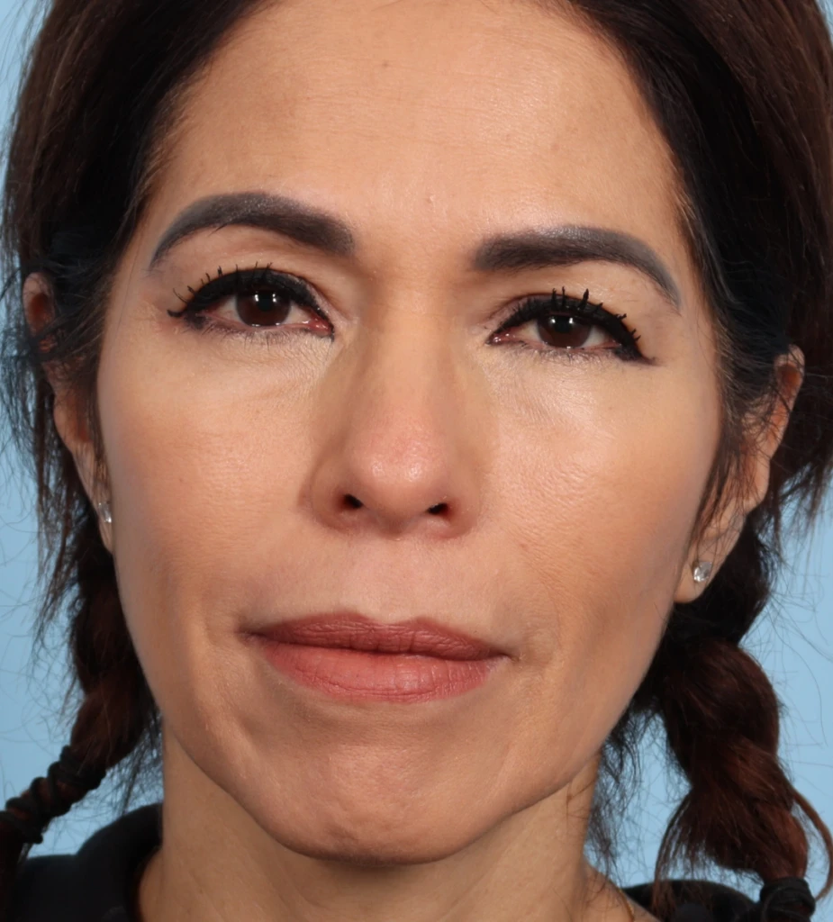 Upper Blepharoplasty 3 B