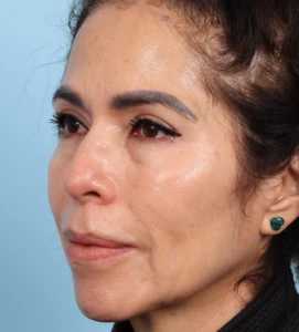 Upper Blepharoplasty 4 A