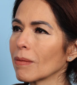 Upper Blepharoplasty 4 B