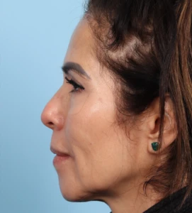 Upper Blepharoplasty 5 A