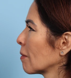 Upper Blepharoplasty 5 B