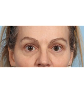 Upper Blepharoplasty 6 A