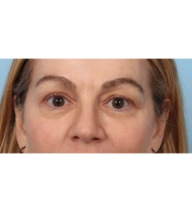 Upper Blepharoplasty 6 B
