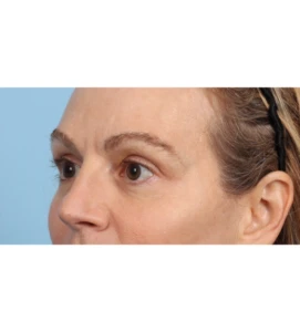 Upper Blepharoplasty 7 A