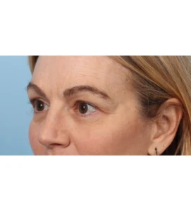 Upper Blepharoplasty 7 B